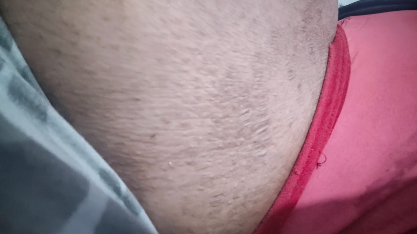 Customer photo review of Creme Clareador de Manchas – Melasma, Axilas, Virilha, Áreas Íntimas, Rosto e Corpo