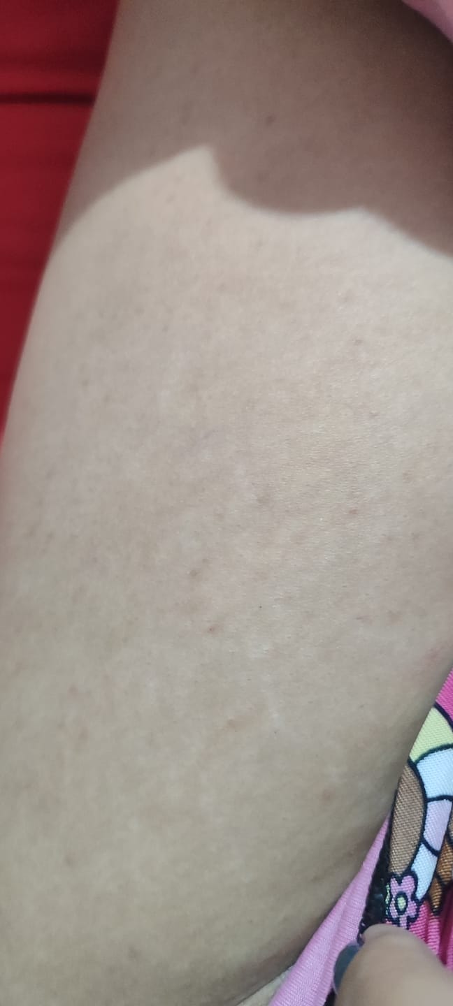 Customer photo review of Creme Antiestrias Regenerador Dérmico